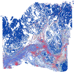  Clustered cells spatially displayed across a Human Lung Cancer tissue section. 